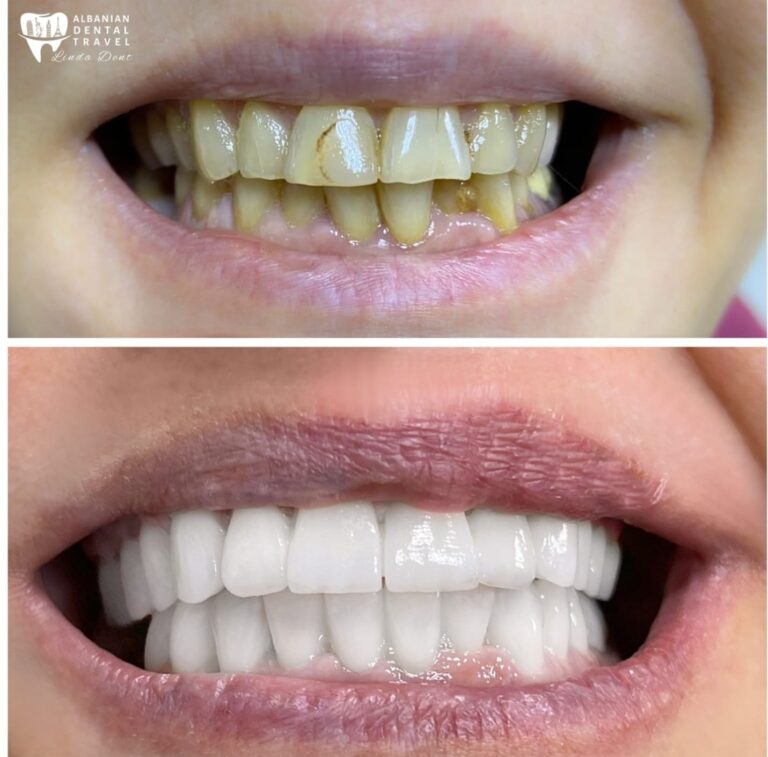 ceramica dentale Albania
