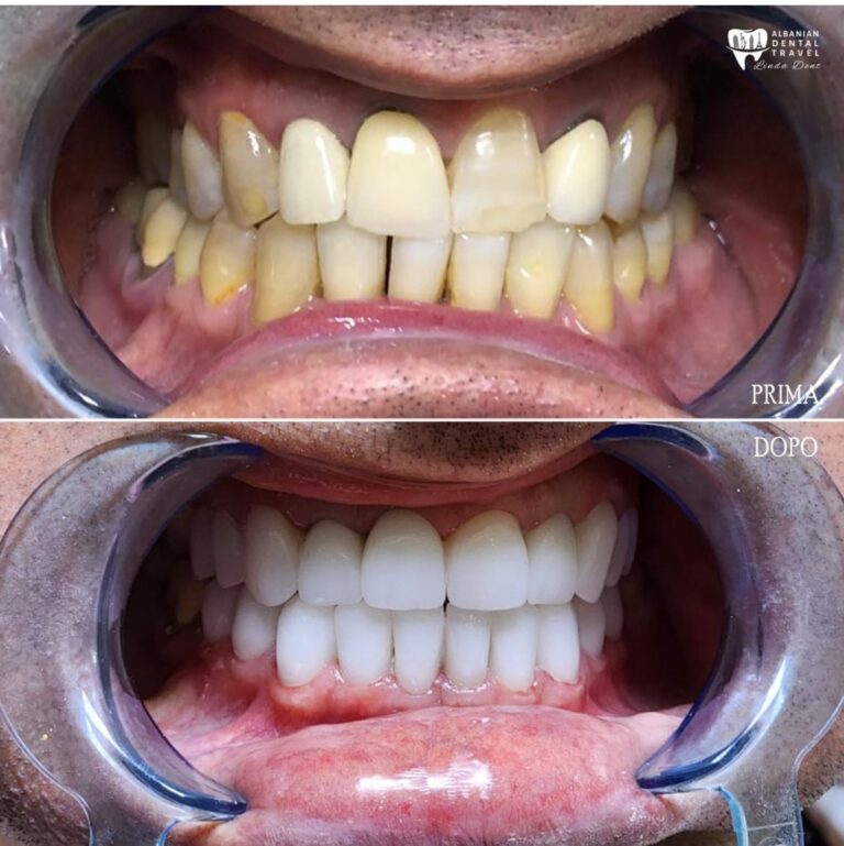 denti in zirconio