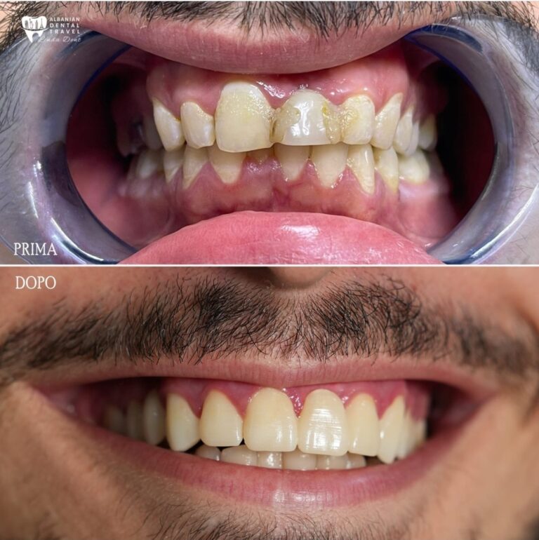 sostituzione denti Albania